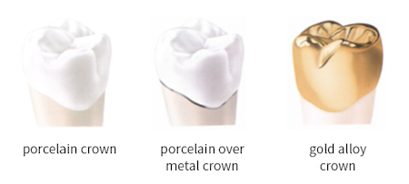 Crown Diagram