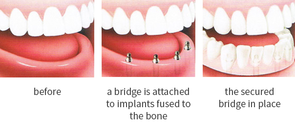 Dental Implants Minneapolis