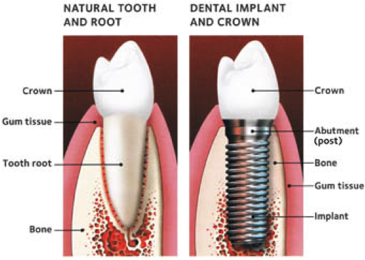 Minneapolis Dental Implants