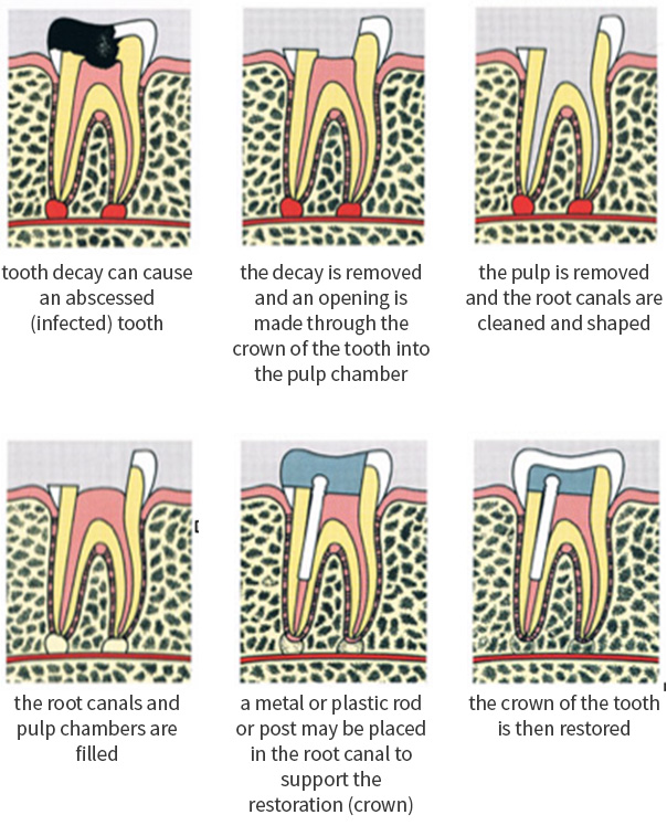 Minneapolis Root Canal Treatment
